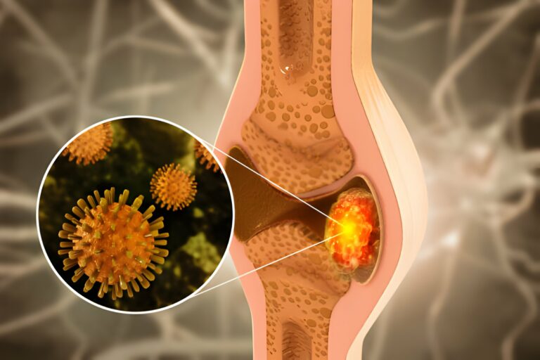 Musculoskeletal cancer