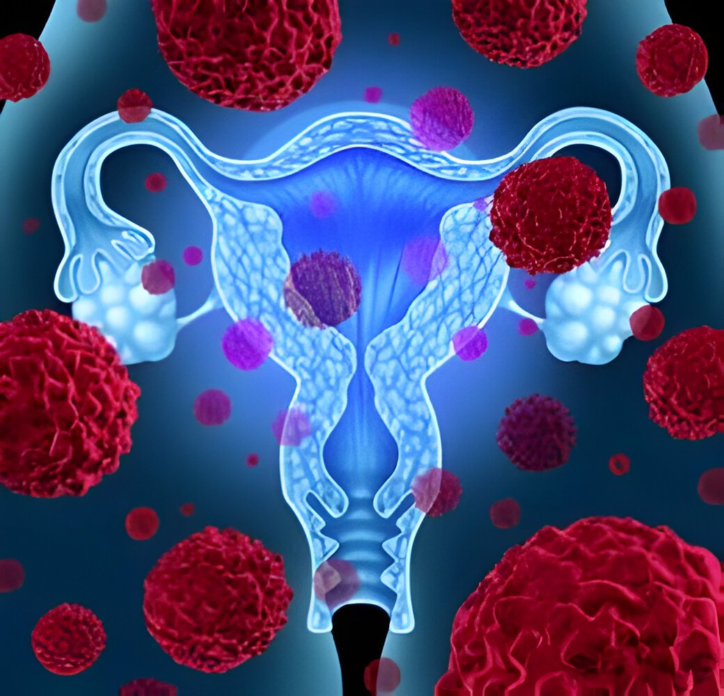 Ovarian cancer Symptoms