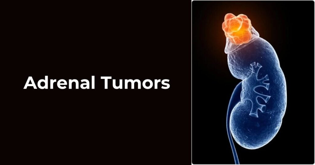 Adrenal Tumors