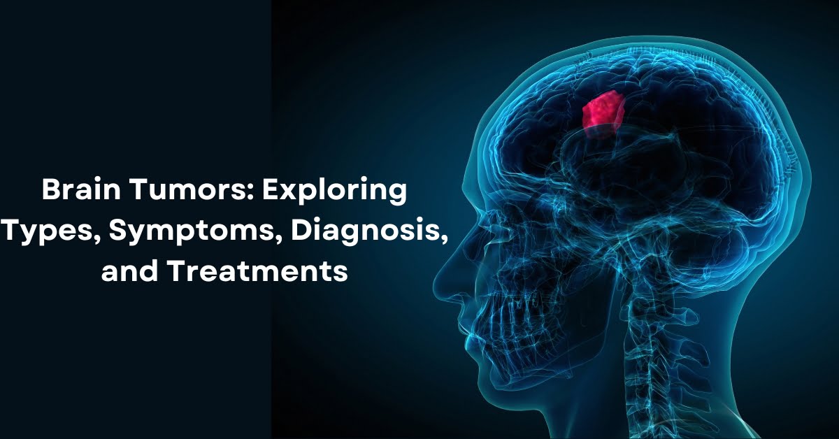 Brain Tumors: Exploring Types, Symptoms, Diagnosis, and Treatments - Pi ...