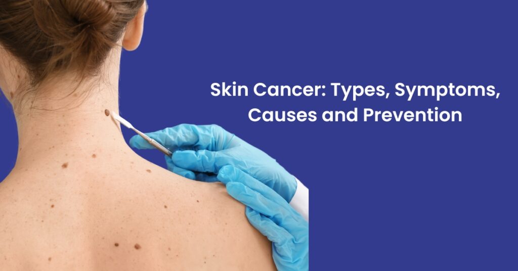 Skin Cancer: Types, Symptoms, Causes and Prevention