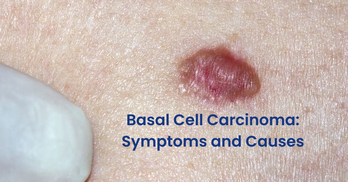 Basal Cell Carcinoma Symptoms and Causes