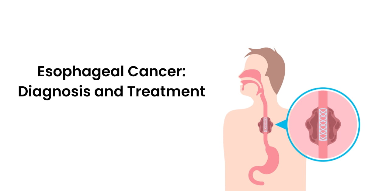 Esophageal Cancer Diagnosis and Treatment